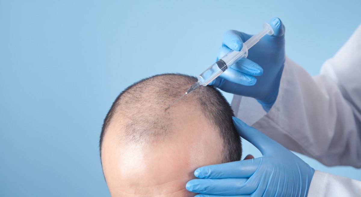 Are baldness cures the next super drug?